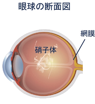 飛蚊症レーザー 塚原眼科医院